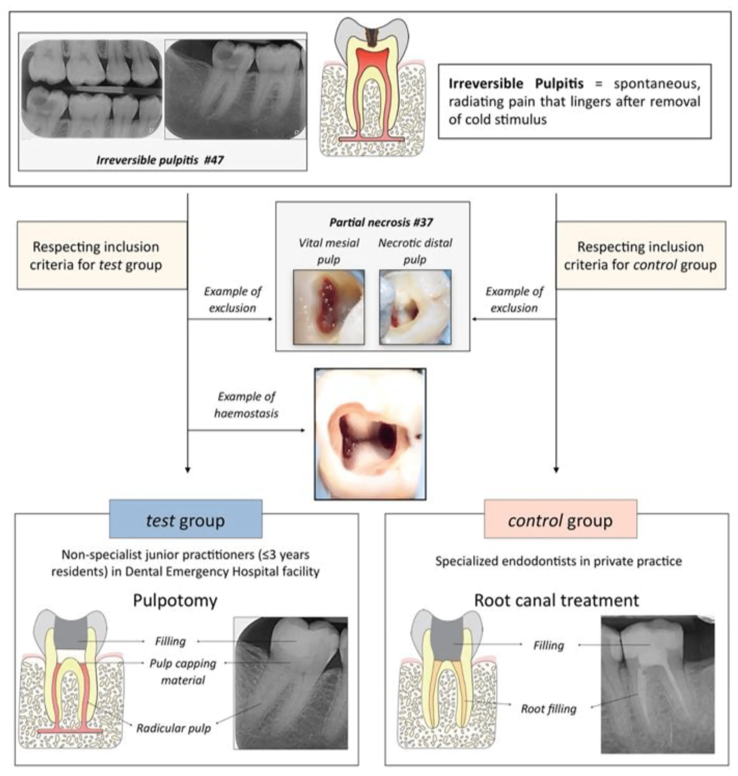 Pulpitis &#8211; what is it, phases, treatment, complications, prevention