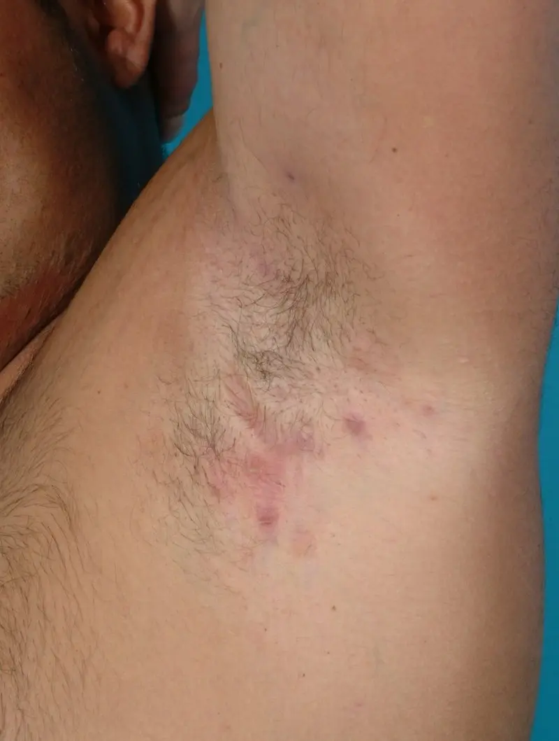 Purulent inflammation of the sweat glands of the armpit