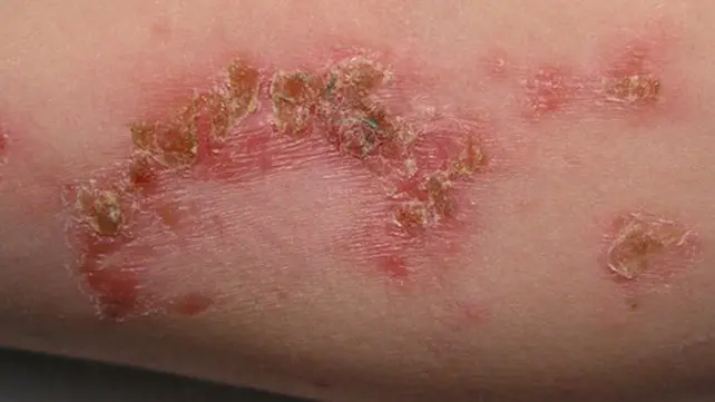 Purulent skin infections &#8211; the most common skin diseases. How to fight them?