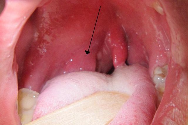 Pus in the throat &#8211; what could be the causes?