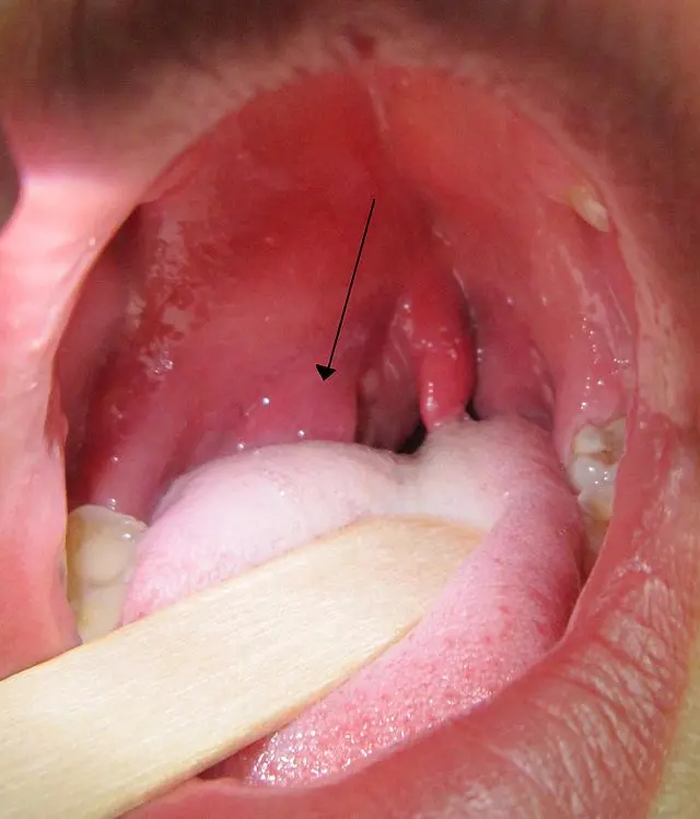 Pus in the throat &#8211; what could be the causes?