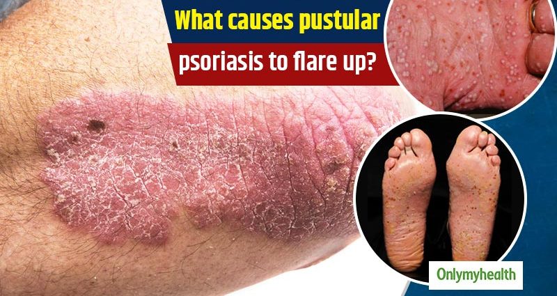 Pustular psoriasis &#8211; causes and types