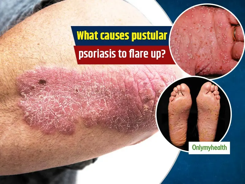 Pustular psoriasis &#8211; causes and types