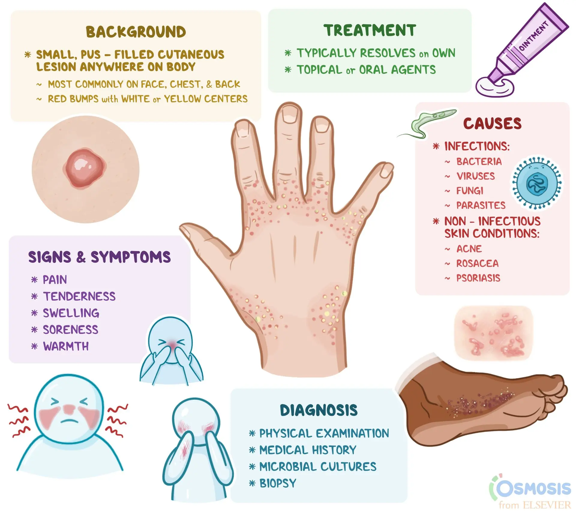 Pustule (pustula) &#8211; causes