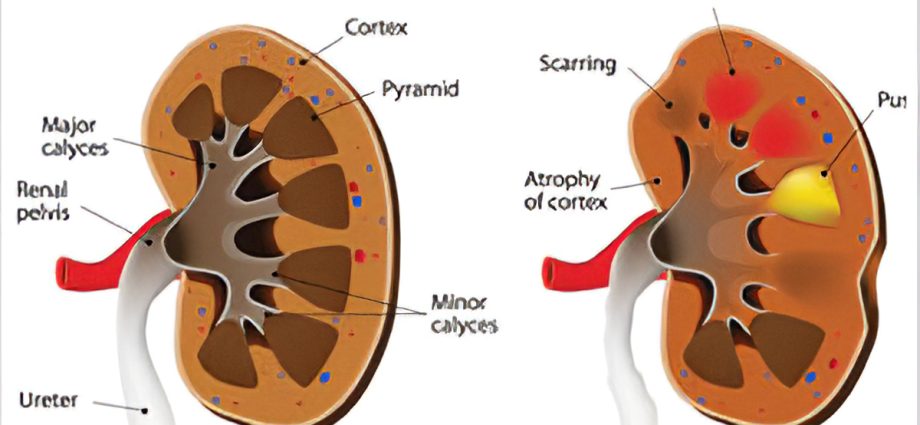 Pyelonephritis &#8211; causes, symptoms, treatment. How is the disease going?