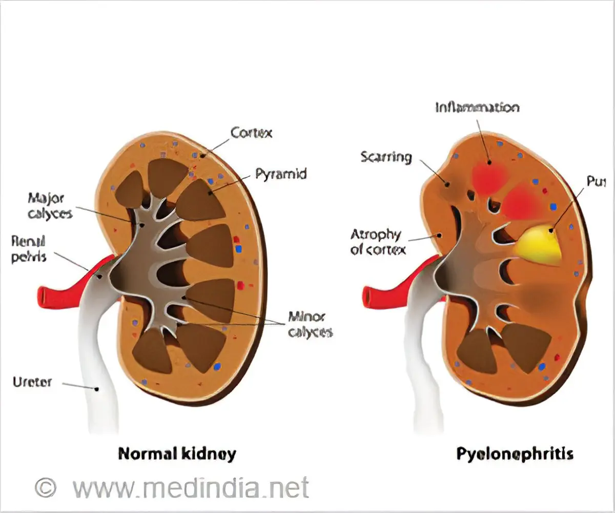 Pyelonephritis &#8211; causes, symptoms, treatment. How is the disease going?