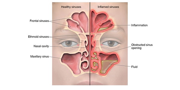 Quixx for diseases of the nasal mucosa and sinuses. How to use?