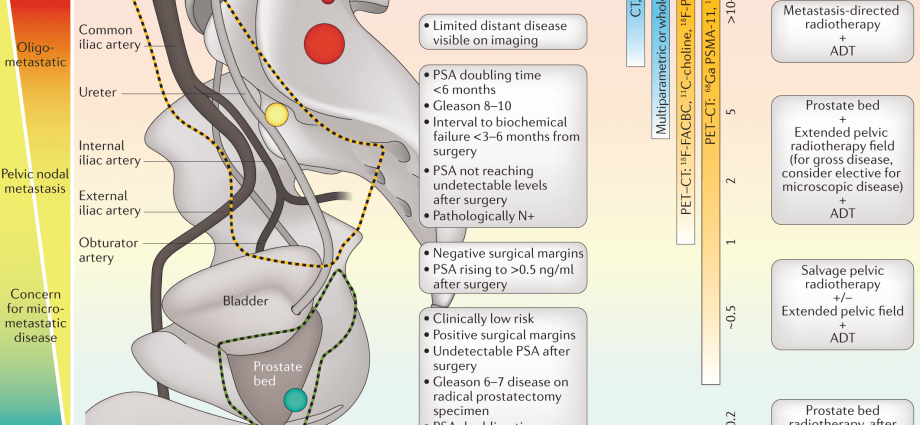 Radical removal of a prostate tumor extends life by 20 years