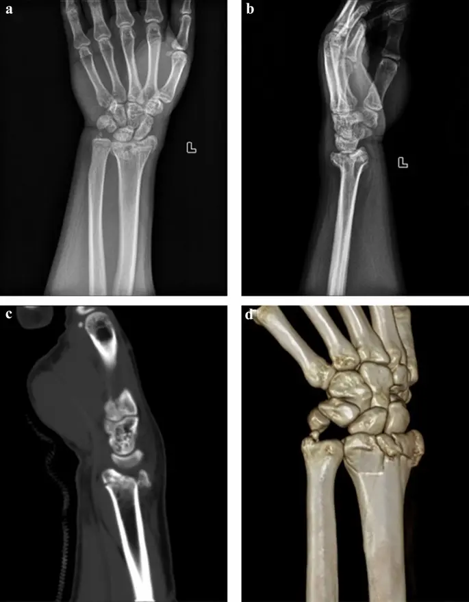 Radius bone &#8211; structure, functions, injuries. Rehabilitation after a radius fracture