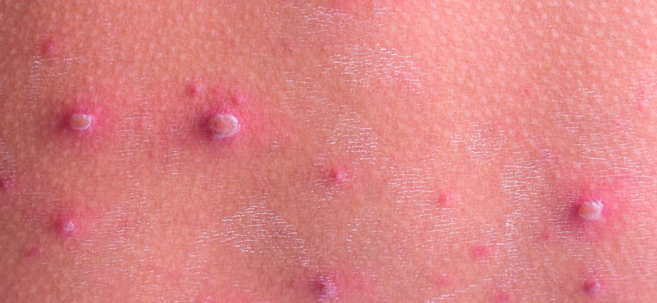 Rash in children &#8211; causes, symptoms, treatment