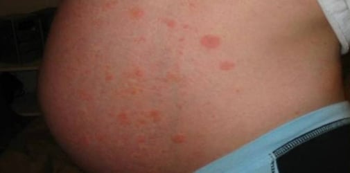 Rash in pregnancy &#8211; how to deal with it?