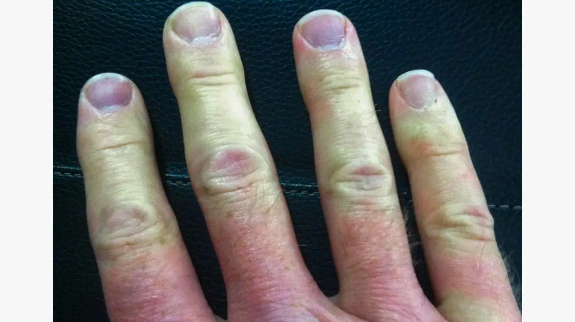 Raynaud&#8217;s phenomenon &#8211; what is this disease?