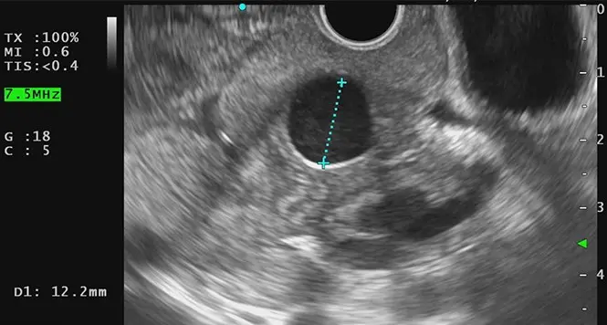 Rectoscopy &#8211; indications, course, results. How to prepare for rectoscopy?