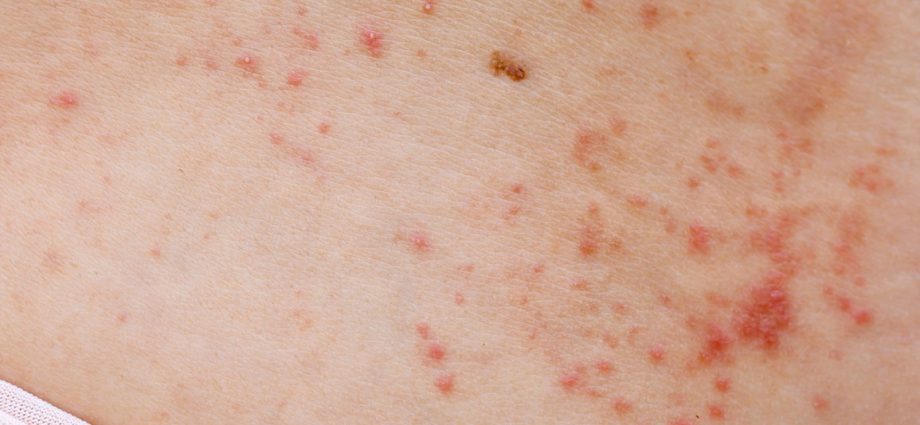 Red dots on the body &#8211; what they mean, treatment