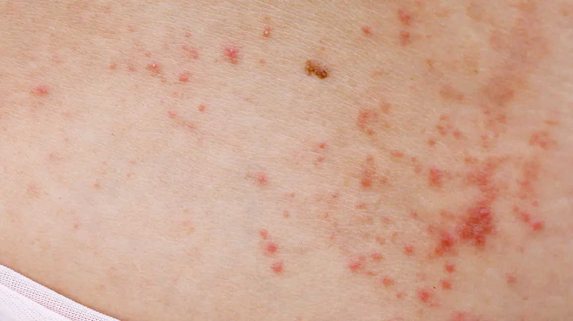 Red dots on the body &#8211; what they mean, treatment