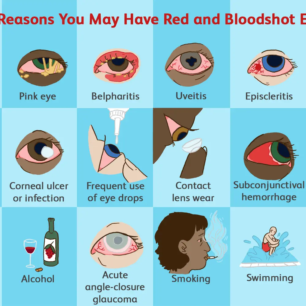 Red eyes &#8211; with glaucoma, how to get rid of