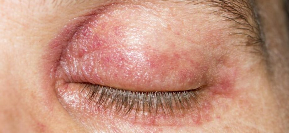 Red, itchy, irritated. How to properly care for the skin around the eyes?