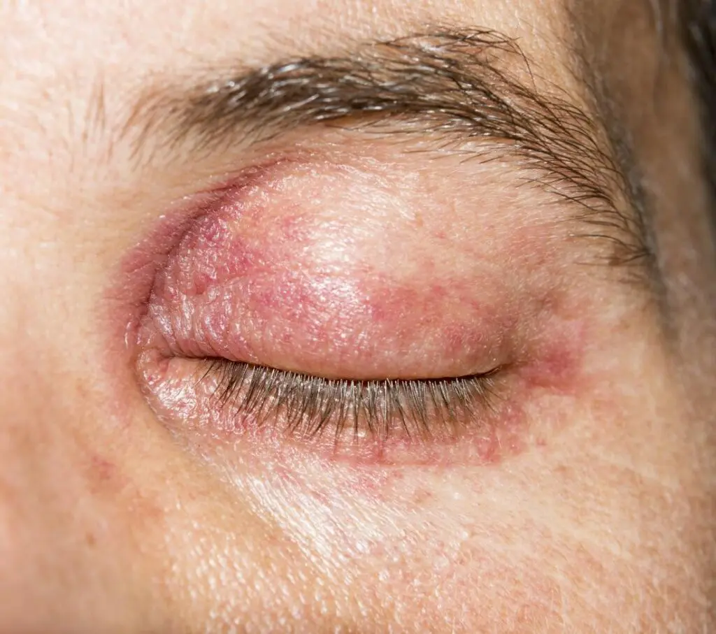 Red, itchy, irritated. How to properly care for the skin around the eyes?