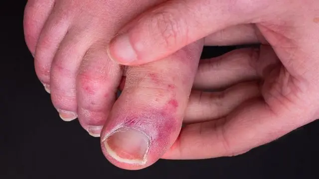 Reddish-purple spots, blisters. What are &#8220;covid fingers&#8221;?