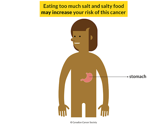 Reducing the amount of salt you eat can help prevent stomach cancer