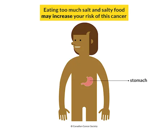 Reducing the amount of salt you eat can help prevent stomach cancer