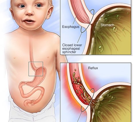 Reflux in infants &#8211; what is it, symptoms, causes, diagnosis