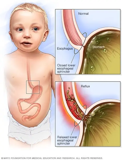 Reflux in infants &#8211; what is it, symptoms, causes, diagnosis