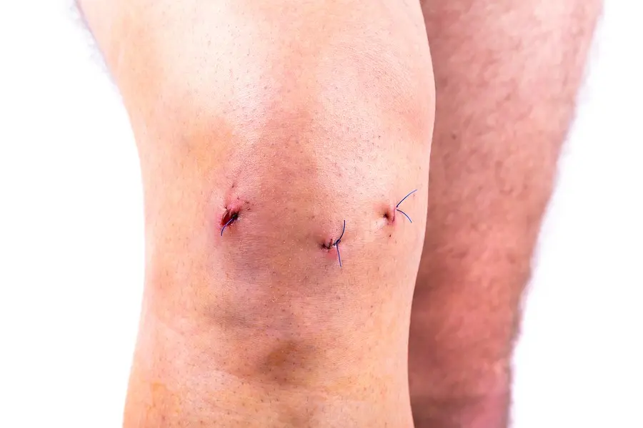 Rehabilitation after arthroscopy &#8211; what does it look like?