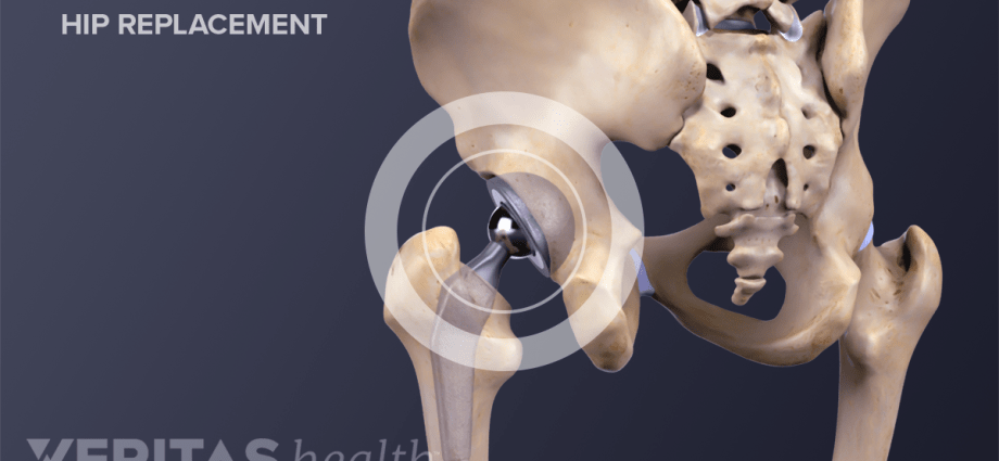 Rehabilitation after implantation of a hip replacement