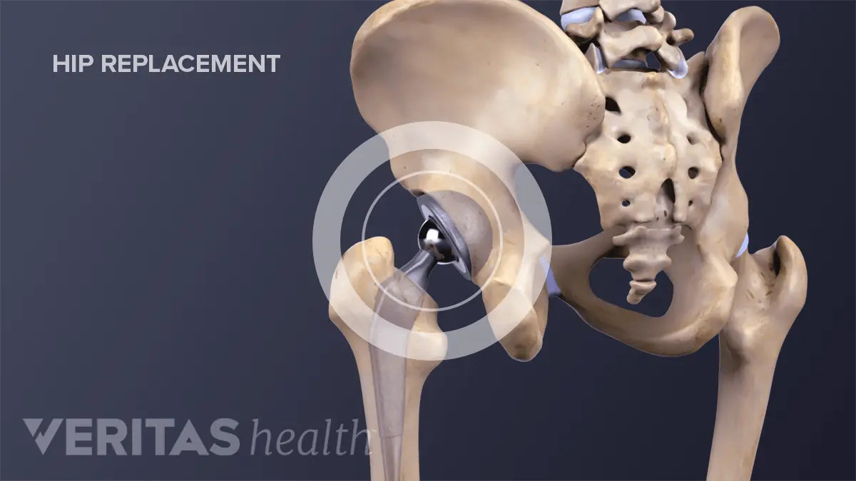 Rehabilitation after implantation of a hip replacement