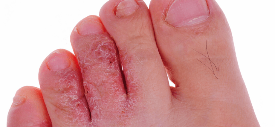 Reinfection after athlete&#8217;s foot &#8211; why is the fight against athlete&#8217;s foot so difficult?