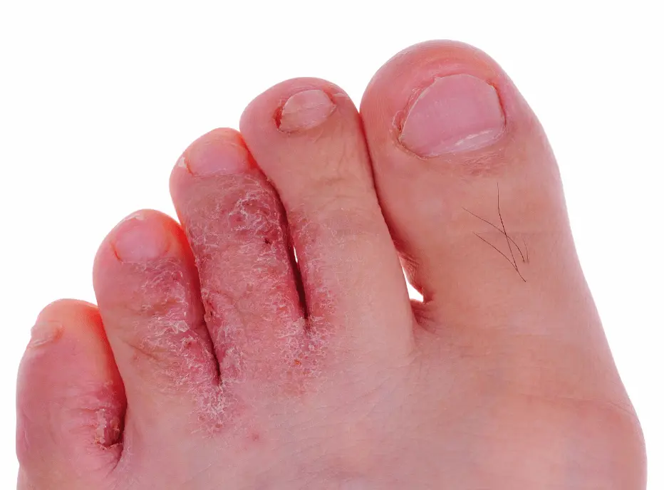 Reinfection after athlete&#8217;s foot &#8211; why is the fight against athlete&#8217;s foot so difficult?