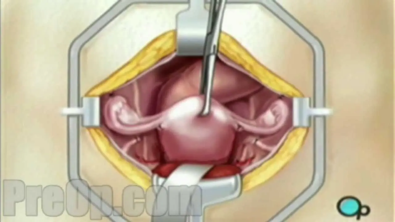 Removal of reproductive organs and sanatorium