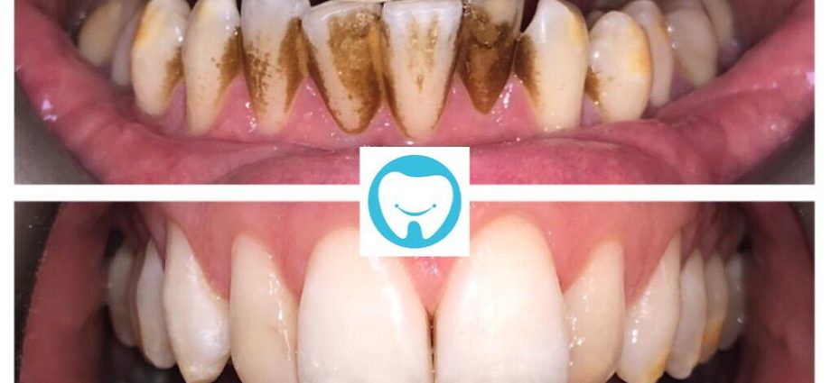 Remove discoloration on teeth