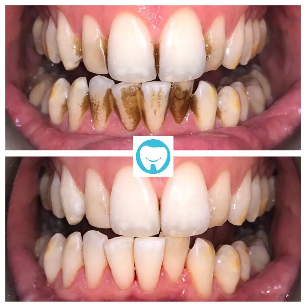 Remove discoloration on teeth