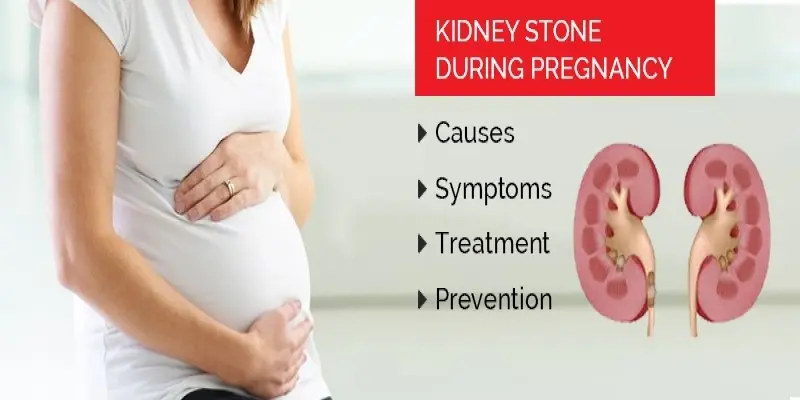 Renal colic in pregnancy &#8211; causes, symptoms