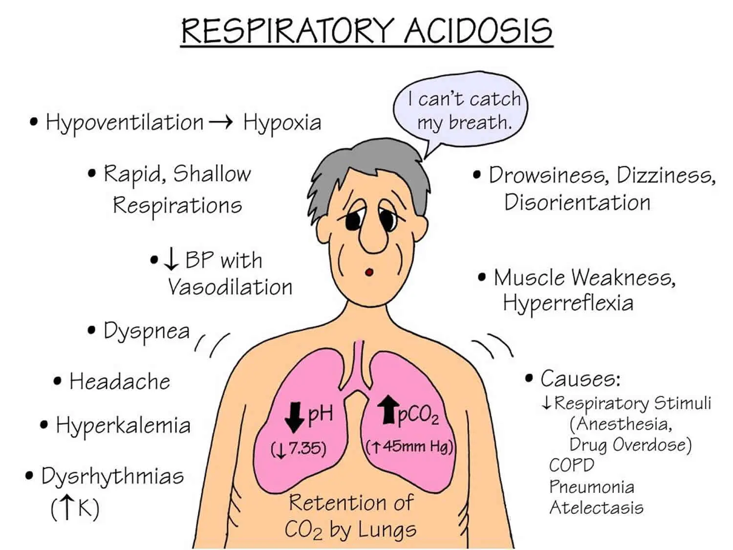 Respiratory acidosis &#8211; causes, symptoms, treatment