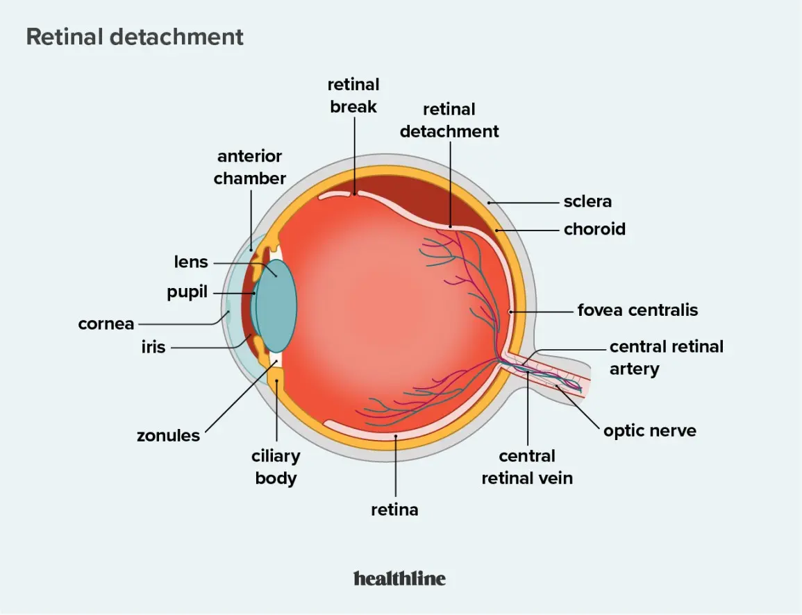 Retinal detachment &#8211; symptoms and treatment