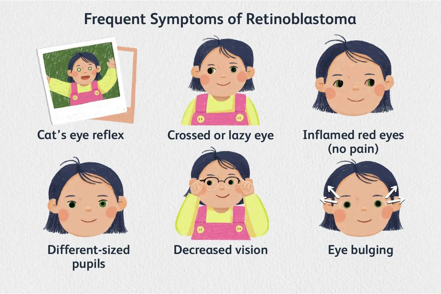 Retinoblastoma &#8211; symptoms, treatment, prevention