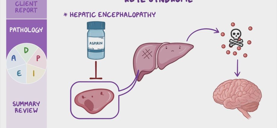 Reye&#8217;s syndrome &#8211; causes, diagnostics, intensive treatment, how to reduce the risk
