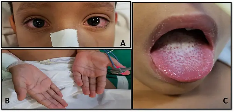 Reye&#8217;s tumor &#8211; where does it appear? Treatment of Reye&#8217;s tumor in infants and children