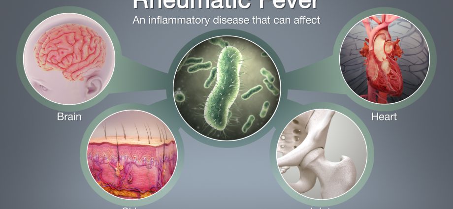 Rheumatic fever &#8211; symptoms and treatment. Is rheumatic fever dangerous?