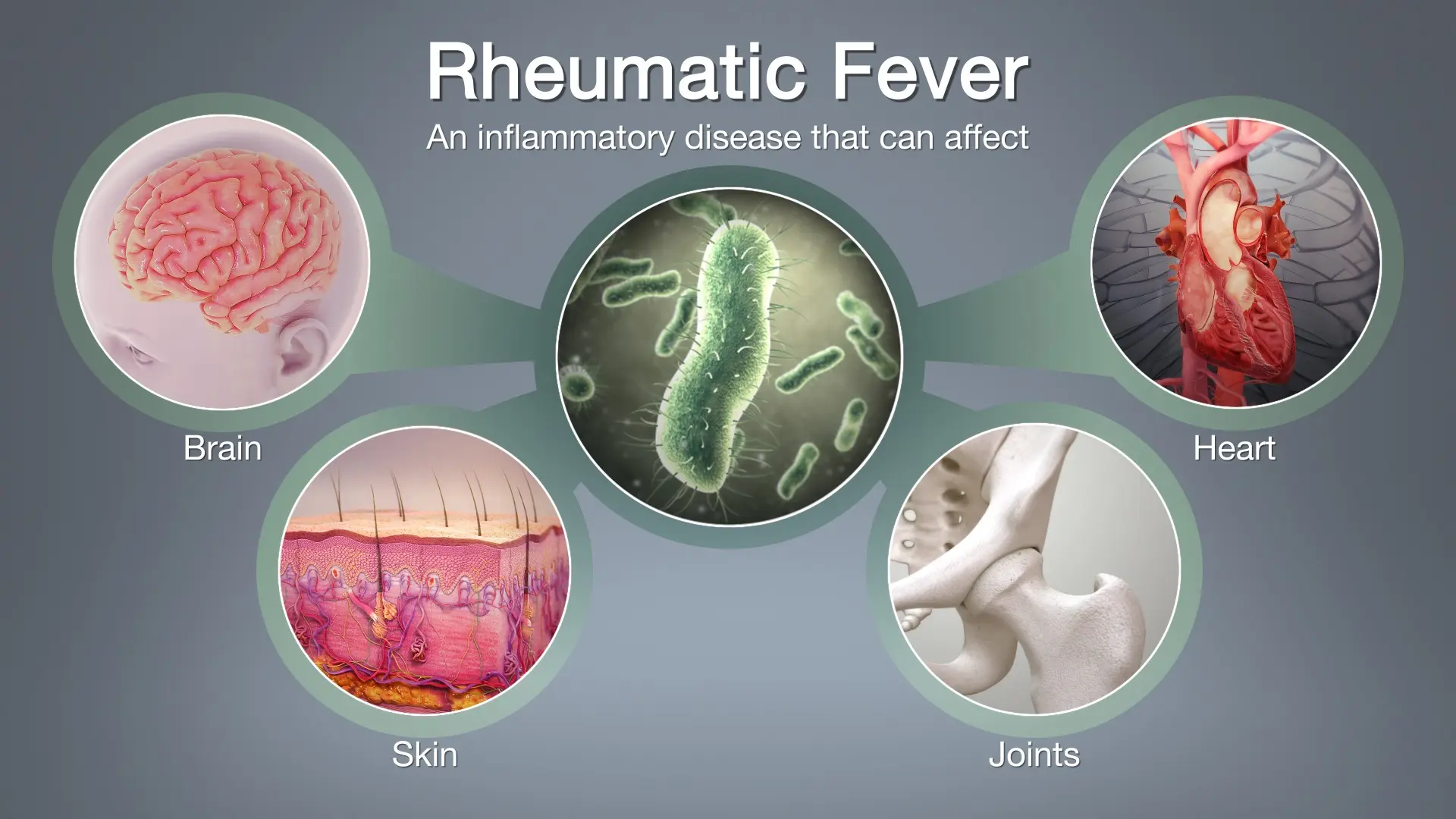 Rheumatic fever &#8211; symptoms and treatment. Is rheumatic fever dangerous?