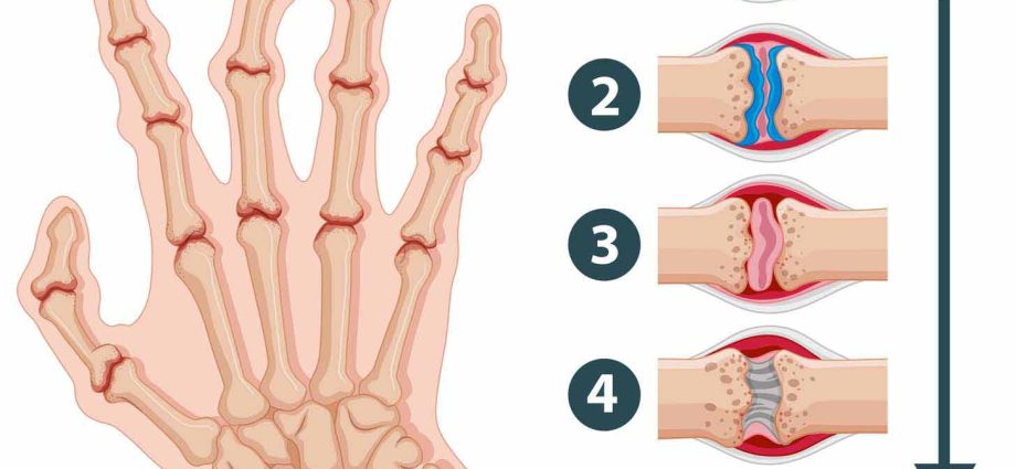 Rheumatoid arthritis (RA) &#8211; an inflammatory disease that can even lead to death. There are ways to heal