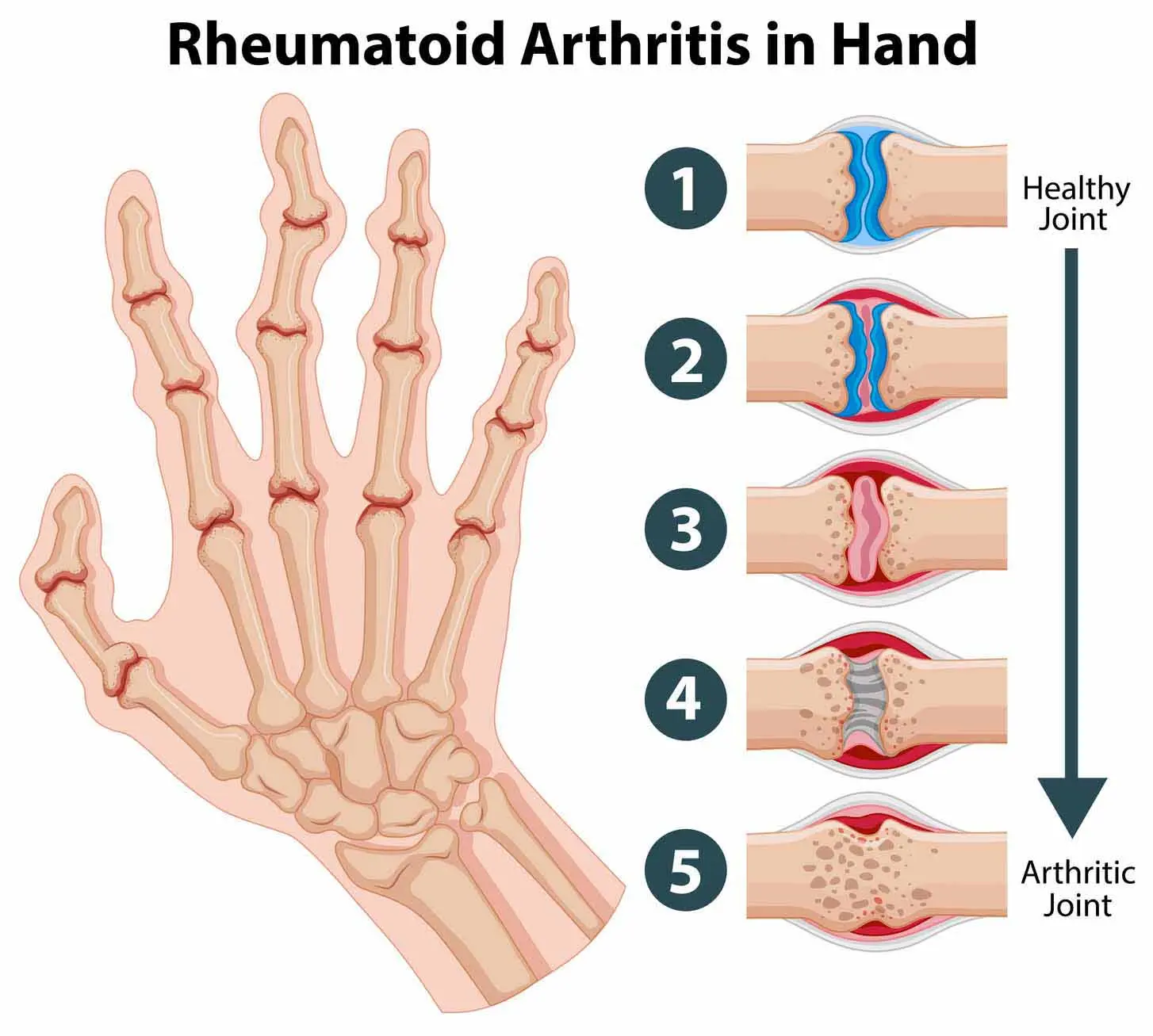 Rheumatoid arthritis (RA) &#8211; an inflammatory disease that can even lead to death. There are ways to heal