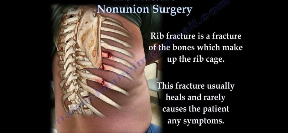 Rib fractures &#8211; treatment