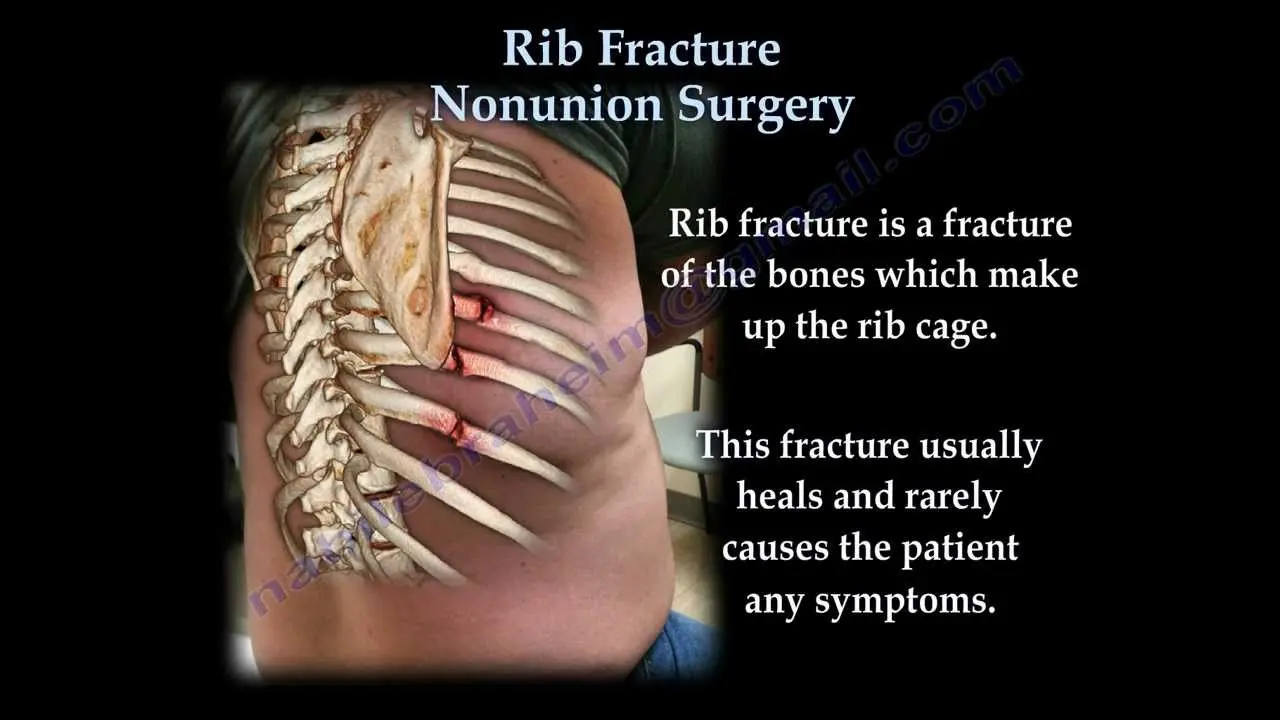 Rib fractures &#8211; treatment