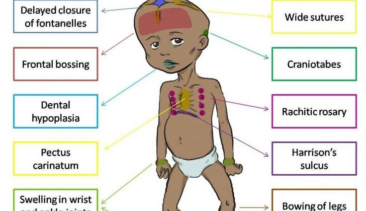 Rickets &#8211; symptoms, causes, treatment