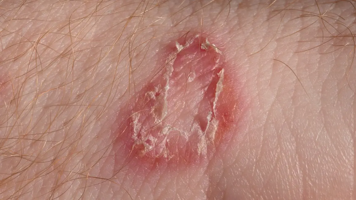 Ringworm of smooth skin &#8211; symptoms, diagnosis, treatment, photos