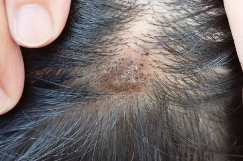 Ringworm &#8211; photos. How to treat scabs on the scalp?